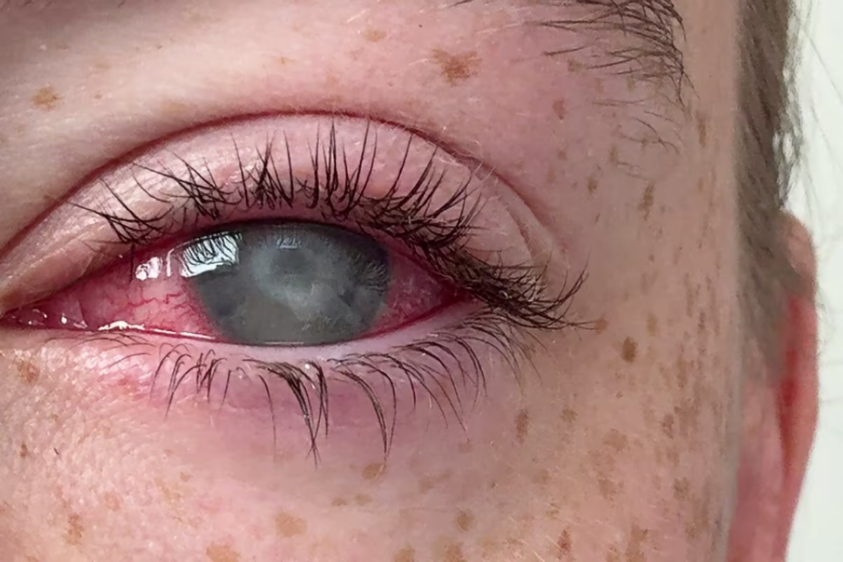 Foto dell'occhio sinistro di Grace Jamison, una donna di 19 anni che ha perso la vista a causa di... una semplice doccia