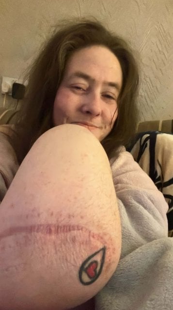 Jayne Stephen dopo la sua amputazione