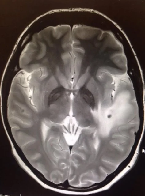 Una scansione del cervello ha rivelato che aveva sviluppato dozzine di parassiti