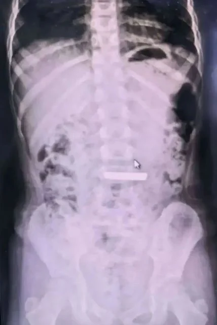 Radiografia che mostra il lingotto d'oro nello stomaco della bambina