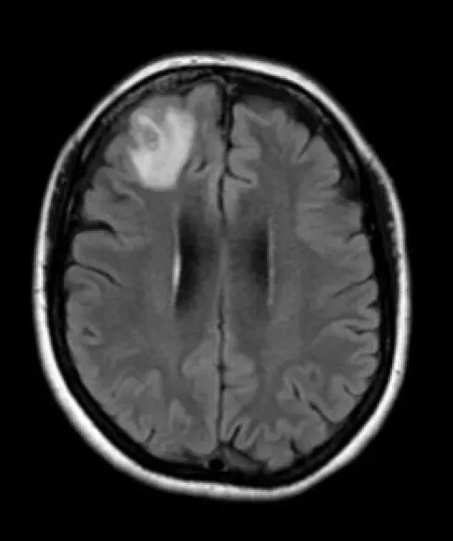 La lesione nel cervello