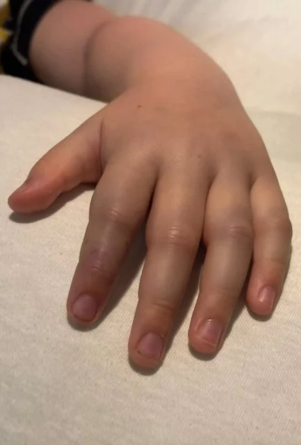 La mano di Kenzie Macrae gonfia dopo essere stata morsa
