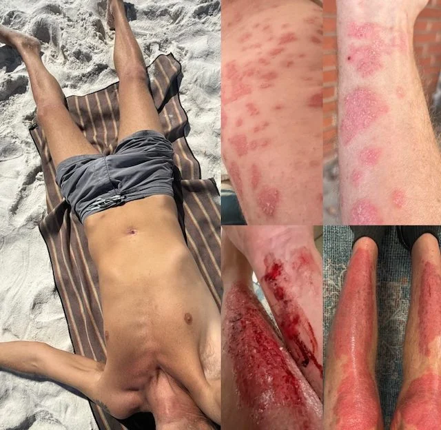 L'evoluzione della psoriasi di Stephen Lashbrook