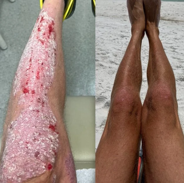 L'evoluzione della psoriasi di Stephen Lashbrook