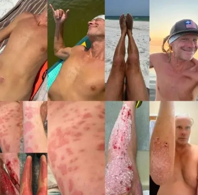 L'evoluzione della psoriasi di Stephen Lashbrook